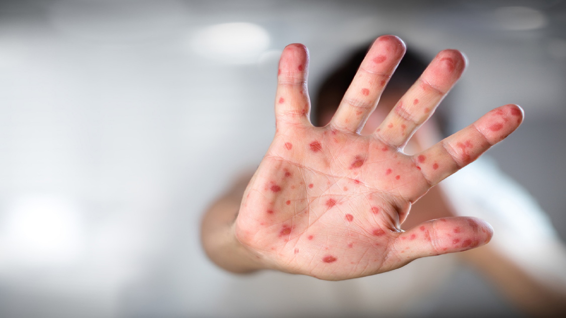 Viral Diseases – Hand Infected – Hand foot and mouth disease HFMD